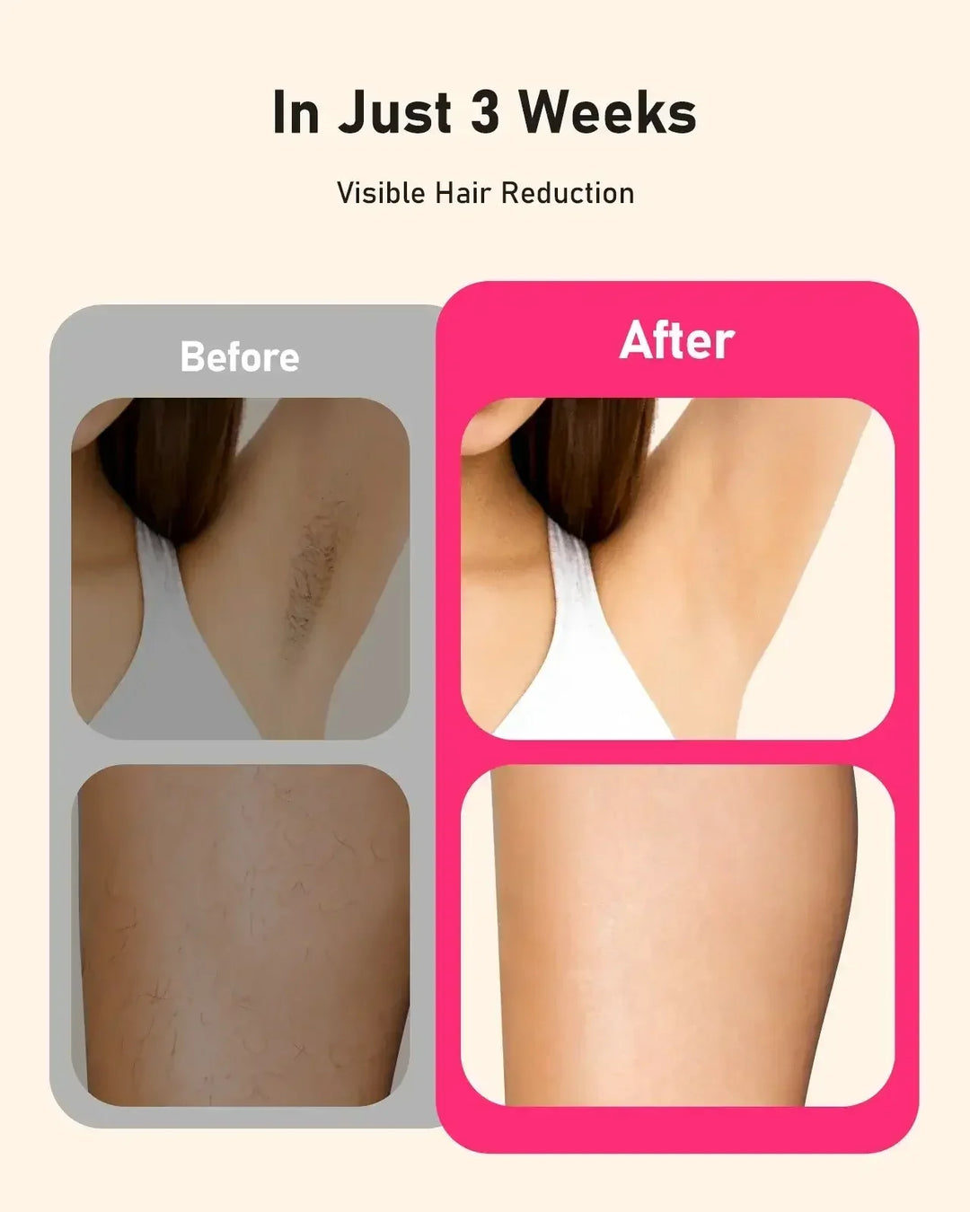 Before and after underarm and leg hair reduction showing smooth skin after 3 weeks