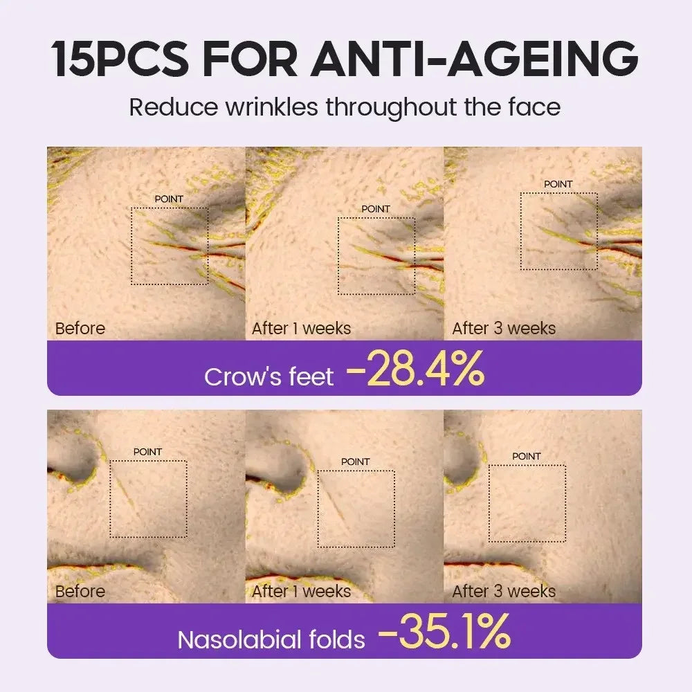 Before and after close-up photos showing 28.4% reduction in crow's feet and 35.1% reduction in nasolabial folds after 3 weeks
