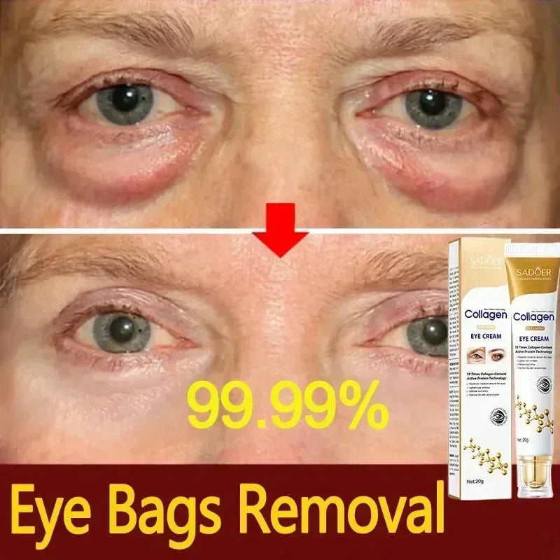 Before and after photo showing reduction of eye bags using collagen eye cream with 99.99% effectiveness