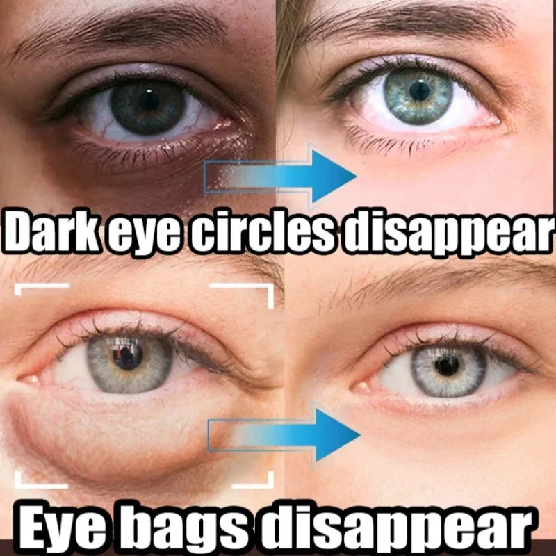 Before and after close-up images showing disappearance of dark eye circles and eye bags on blue eyes