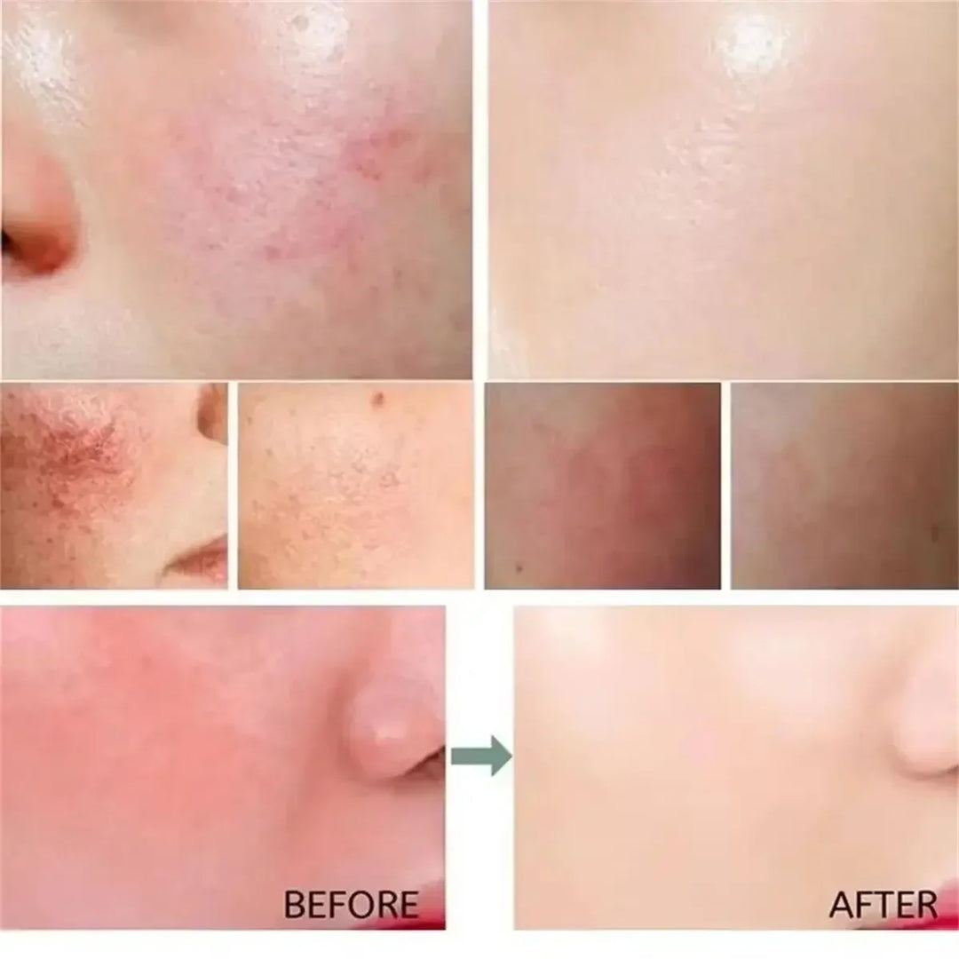 Before and after close-up images showing improved skin redness and acne scarring treatment results